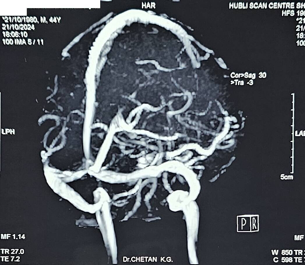 04-unconscious-after-stopping-alcohol--a-case-of-seizures-fits-after-stopping-ethanol-usage---management-by-dr-chetan-k-ganteppanavar-consultant-physician-kalpana-multi-specialty-clinic-hubli---dharwad-karnataka-india-thumbnail