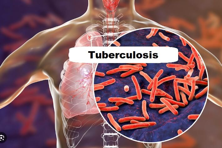 07-tuberculosis-masquerading-as-arthritis-poncets-disease-a-diagnostic-challenge--hubli-india-thumbnail