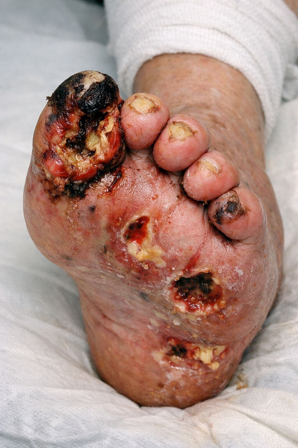 22-save-your-feet-save-your-life--diabetic-foot-care-at-kalpana-multispeciality-clinic-hubballi-thumbnail